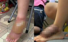 5歲兒腳部燙傷母懶理等覆診 拖一年後肉牙增生網民斥虐兒