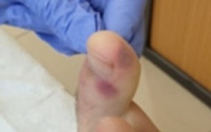 西班牙專家稱腳趾起痘或為新冠病毒早期症狀