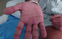 猴痘｜34岁男子确诊猴痘  密切接触者曾到韩国及台湾外游