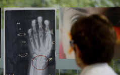 米蘭醫院展出X光片 凸顯女性遭受家暴猖獗