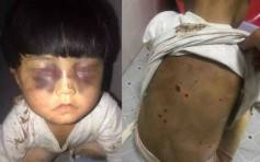 貴州恐怖虐兒案 4歲女童慘遭煙頭辣背 全身瘀青雙眼紅腫