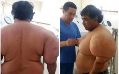 秘鲁渔民患「潜水夫病」 上身肿胀如大力水手