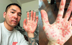 美华裔男患猴痘被多次误诊 致病情恶化险盲
