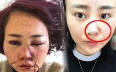 丽江遭殴毁容女：医生说疤痕100万都退不了