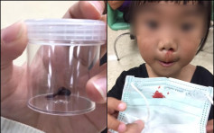台2岁女嬉水误吸入水蛭 持续十多天狂流鼻血 