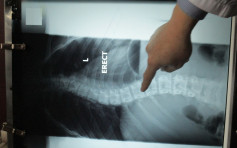 衞生署承辦商為學生進行脊柱X光檢查時 疑未有妥善使用乳腺及生殖腺屏蔽裝置
