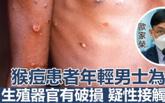 猴痘蔓延｜欧家荣指患者年轻男士为主 料对香港风险较低