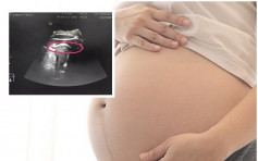 深圳孕婦遭胎兒踢穿子宮 剖腹生產母子平安