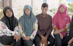 印尼四兄妹罹患怪病長相如河馬 受盡歧視仍樂觀面對