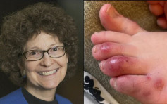 美国专家曝儿童无症状感染者 脚趾起痘布鲜红肿块