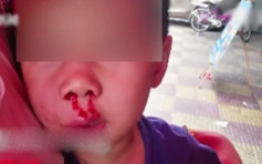 厦门4岁童与男子碰撞后 遭一脚踢至昏迷脑出血