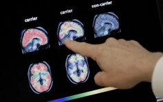 牛津大學研究：新冠病毒導致大腦老化十年