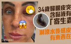 34岁妇眼皮突爆含黏液有脚「寄生虫」淋滚水后感皮下有东西在爬