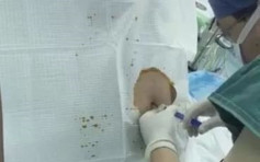 【片段】杭州268磅孕妇疯狂进补 医生开刀缝针「针针冒油」