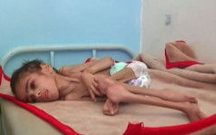 也門內戰釀嚴重飢荒 7歲男童皮包骨營養不良僅重7公斤