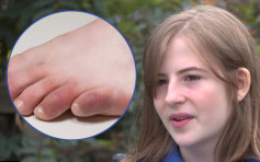 13岁少女患「新冠脚趾」浮肿发紫起水泡 但检测呈阴性