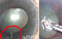 印妇寄生虫入眼 施手术取出1厘米长活虫