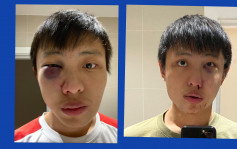 疫情引发歧视 新加坡留学生伦敦街头遭围殴