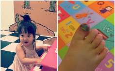 1歲女腳趾紅腫發黑 台星六月超心疼