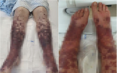 34歲女接種阿斯利康疫苗現嚴重過敏 手腳長滿血泡險截肢