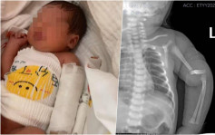 安徽男婴出世仅一天离奇手臂骨折 医院拒认责