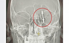 恐怖植牙！牙医疑用力过猛  螺丝钉插穿病人头骨直嵌大脑