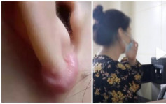 18歲女穿耳洞後連日發燒  診斷後證實顱內感染兼肝腎功能受損