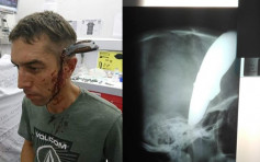 南非汉遇劫头插15cm长刀 自行踩单车求诊
