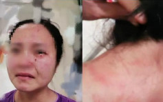外籍确诊患者拒抽血 殴打并咬伤护士脸部