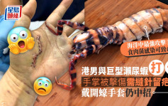 港男與巨型瀨尿蝦打卡被擊傷手掌留長傷口 衞生防護中心：食肉菌感染可致命