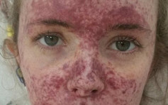 澳洲女滿臉紅疹誤以為患流感 求診始驚覺與死神擦身而過