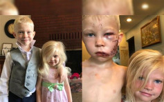 六岁男护妹遭恶犬咬伤 送院缝90针