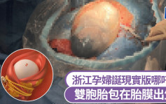 哪吒现实版？浙江一对双胞胎包裹在胎膜内出生