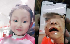 黑龍江被生父繼母虐打4歲女童已甦醒能進食