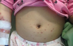 四肢布满红疹 台中6岁女童患过敏性紫斑症