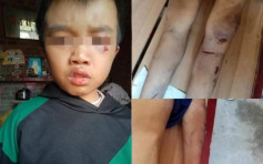 江西12岁男童满身伤痕倒毙家中 警：父母虐待致死