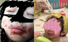 大人喂食「口水尾」 台一岁女童惨被传染疱疹