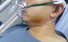 湖南26岁男挤暗疮后 呼吸衰竭患败血症