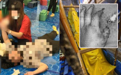 台灣10歲男童玩滑梯 大拇指慘被尼龍繩切開兩截