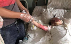 浙江兩歲女童掉進170度油鍋 父母心急幫脫衣結果連皮撕下