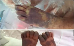 初生女嬰被老鼠抓傷尾指 病毒感染手腳發紫休克