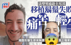 整容變毀容｜法國型男移植鬍鬚失敗痛苦自盡 開刀無牌「醫生」竟是地產經紀