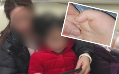 家長手機當「哄娃神器」 3歲女患「扳機指」