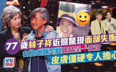 77歲林子祥近照驚現面部失衡？右臉明顯歪斜眼睛呈一狀況  皮膚僵硬令人擔心