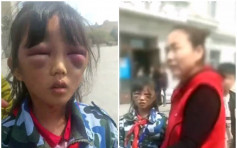 黑龙江女童疑被虐待双眼肿如核桃 继母被扣留调查