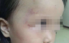广州2岁女童不按时午睡 被幼儿园老师殴打