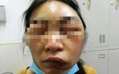 女子睡醒臉部暴腫差點窒息 以為被蚊叮就醫才知真相