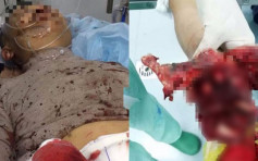 湖南27歲青年玩「魚雷」爆竹 炸斷右手與小腸