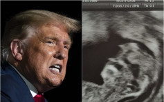 英孕婦分享胎兒超音波照片:「怎麼長得像特朗普？」