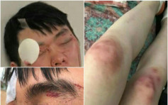 多名中國留學生遭澳洲青年圍毆 一人眉骨裂開短暫失明